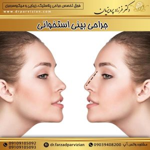جراحی بینی استخوانی - دکتر فرزاد پرویزیان